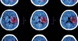 Brain injury scan result of patient from car accident.